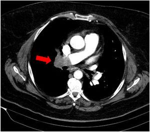 Repletion defect in right pulmonary artery on the axial thoracic CT scan.
