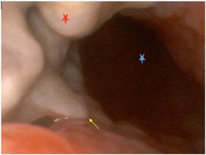 Video-bronchoscopy image.
