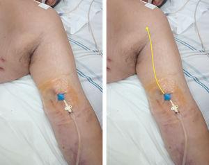 Midline catheter (16G, 20cm in length) placed in the left arm of a critical care patient with COVID-19. On the right, a yellow line is illustrating the catheter path and the position of the tip in the axillary region (axillary vein). Modified from Blanco P. The midline venous catheter. Rev Hosp Emilio Ferreyra. 2021; 1(1):e3–e9. http://revista.deiferreyra.com/index.php/RHEF/article/view/31/89. (CC BY 4.0).
