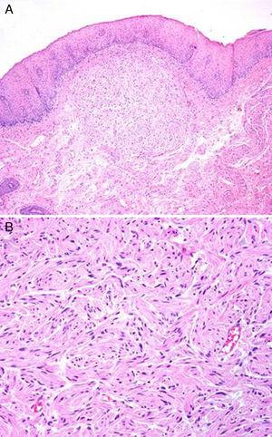 Multiple Mucosal Neuromas in the Larynx as Part of a Multiple Endocrine ...