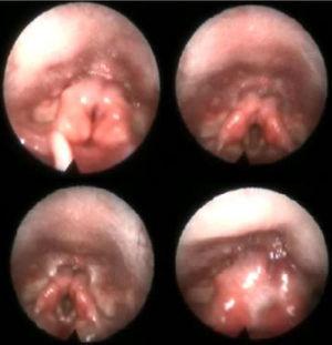Case 1 video endoscopy where protruding hypertrophic mucosa of the arytenoids secondary to the defect is noted.
