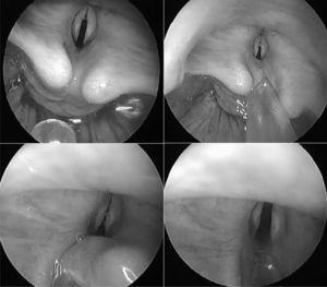 Confirmation of the defect on probing of the cleft while pushing back the posterior laryngeal wall.
