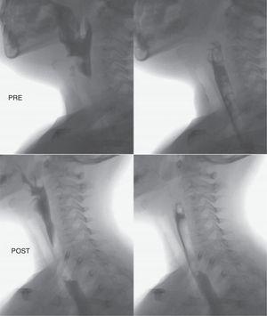 Video fluoroscopic study of swallowing before and after surgery.