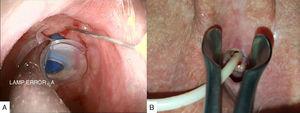 (A) Combined technique, the collar can be seen around the prosthesis. The injection of hyaluronic acid into the tracheoesophageal wall adjusts the wall to the diameter of the prosthesis. (B) Nasogastric tube placed through the fistuloplasty in order to reduce it.