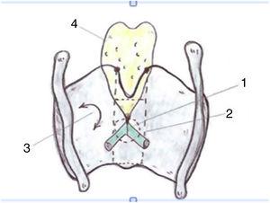Proposed definition of the anterior commissure (AC) of the larynx (posterior view). 1. “Classical” AC: insertion of the glottic level excluding thyroid cartilage; 2. “Developmental” AC: 3 levels of insertion (supra, glottic and subglottic) including intermediate thyroid lamina. 3. Lateral thyroid lamina; 4. Epiglottic cartilage (images reproduced by permission of the author).