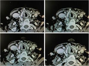 CT images in axial sections with anterior commissure involvement.