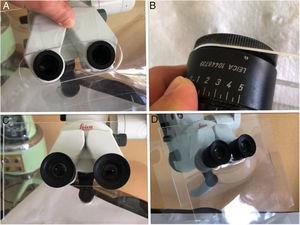A) Methacrylate screen fitted to the microscope after removal of binoculars. B) Adaptation of binoculars to the methacrylate allowing adjustment of the interpupillary distance. C) Adjustment of the binoculars to the microscope together with the methacrylate screen. D) Interposed and replaceable plastic screen to improve the sealing of the methacrylate.