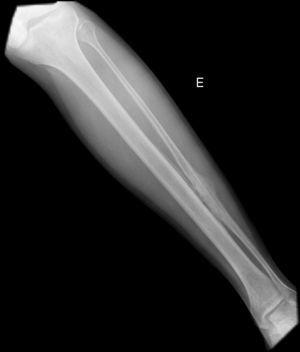 Melorheostosis, a Case Report | Reumatología Clínica