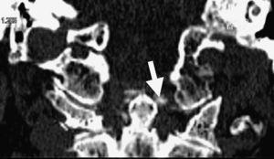 Cervical CT: calcification of the transverse odontoid ligament (coronal).