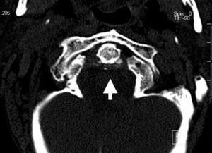 Cervical CT: calcification of the transverse odontoid ligament (axial).