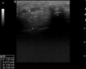 Transverse image of the right median nerve at the entrance of the carpal tunnel, with measurement of the nerve area with an ellipse (0.17cm2), at the pisiform level P (B: large bone). (Image obtained with a General Electrics LOGIC e ultrasound, with a lineal 8–12mHz transducer, using a frequency of 12mHz and maximal enlargement.)