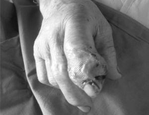 Septic arthritis due to S. lugdunensis, with affection of the distal interphalangeal joint of the second finger of the right hand.