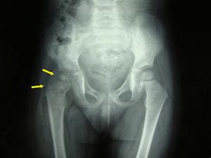 Simple hip X-ray: de-structuration of the right femoral head.
