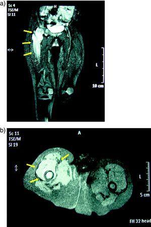 a) Hip MR. b) Right hip MR: septic right coxofemoral osteoarthritis with femoral osteomyelitis that affects the proximal half of the femur.