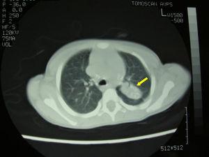 Thorax CT: calcified mediastinal adenopathy with apical and posterior upper left lung lobe segment consolidation, also calcified.