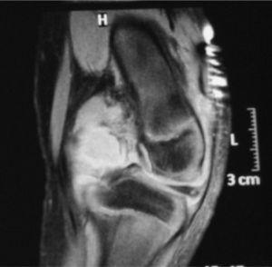MR of the left knee. The joint space shows occupation of the intercondylar notch and posterior recesses.