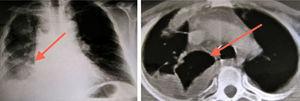 Chest X-ray (left) and CT (right) showing an infiltrate at the right lung base and pleural effusion on the same side.