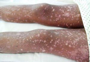 Image of the legs with the characteristic alternating hypo and hyperpigmented macules of the poikilodermatosis.