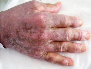 Image of the hands showing Gottron's papules on the metacarpophalangeal joints superimposed on the poikilodermatosis hypopigmented lesions.