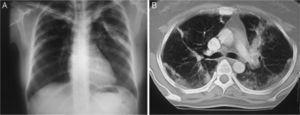 (A) Chest radiograph showing a pulmonary consolidation area in the left upper hemithorax. (B) Axial CT at the level of the tracheal carina showing peripheral areas of consolidation in both hemithorax.