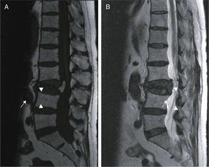 Vertebral Osteonecrosis as a Complication of Steroid Treatment: The ...