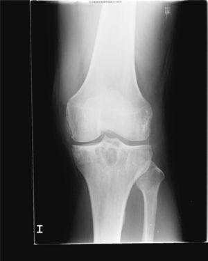 Anteroposterior X-ray of the left knee: well demarcated lytic lesions are objectified in tibial epiphysis with incipient femorotibial degenerative changes.