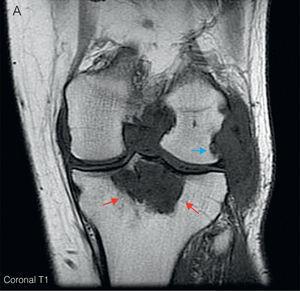 (A) Left knee coronal T1MRI. It shows a diffuse hypointense synovial proliferation with bone erosion of the posterolateral margin of the femoral condyle (blue arrow) and intercondylar notch. A hypointense lytic lesion is seen in the proximal tibial epiphysis with a maximum diameter of 5cm (red arrows). (B) Sagittal T2. There is an increased signal heterogeneity at the level of the tibial epiphyseal lytic lesion (red arrows), along with a large Baker's cyst located behind the medial gastrocnemius muscle (green arrows), with areas of high and low signal for synovial hypertrophy. (C) Sagittal T1-Gd. After administration of gadolinium, enhancement shows the level of peripheral tibial lytic lesion (red arrows) and Baker's cyst (green arrows). (For interpretation of the references to color in this figure legend, the reader is referred to the web version of the article.)