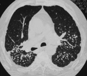 Pneumoconiosi e noduli reumatoidi polmonari.