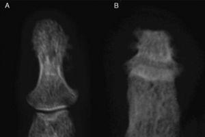 Comparative image of the distal phalange of the hand (A) and foot (B); the first has proliferative changes and the second destructive changes with flattened morphology.