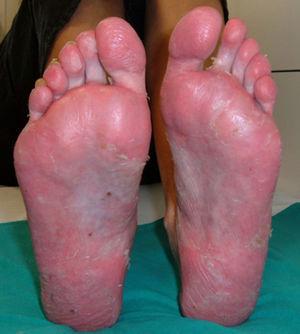 Plantar pustulosis with nail affection in a patient with fistulizing Crohn's disease after onset of treatment with adalimumab.