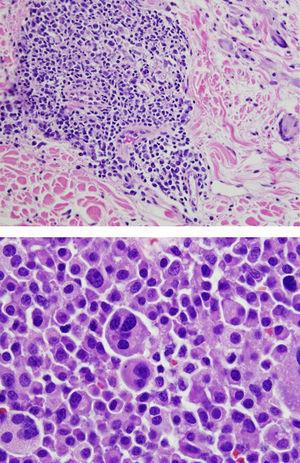 Right axillary lymph node biopsy showing a plasmacytoblastic lymphoma under a hematoxylin–eosin stain.