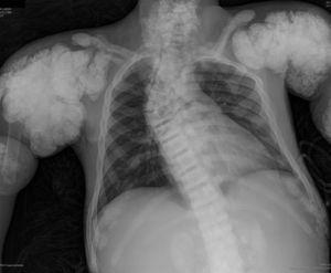 Nodular calcifications of the shoulders. Superior and inferior vertebral plate osteosclerosis (rugby jersey spine) and vertebral collapse of dorsal vertebrae 5 and 6. Bulbous growth on the ends of the ribs and clavicles. Osteosclerosis of clavicles and rib fracture sequelae. Fracture of the right humerus.