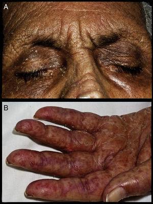 (A) Facial erythema and heliotrope rash. (B) Universal dermatosis characterized by erythema and scaling (palm).