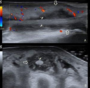 Ultrasound of the dorsal region of the left foot. (A) Longitudinal section of the third toe extensor. (B) Cross section of the same tendon. Hollow arrow: limits of the tendon sheath. Arrowhead: limits of the tendon within the sheath.