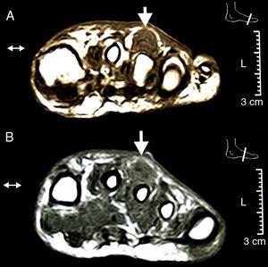 MRI of the foot in two cross sections: distal third in the upper image and middle third in the lower image. The effusion and hypertrophy of the sheath and the integrity of the cortical bone and lack of skin involvement can be observed.