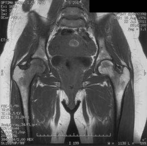 MRI Indicative of a Bilateral TOH.
