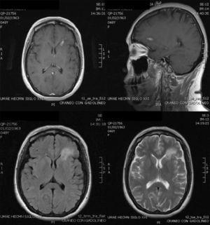 MRI on admission: CSF spaces, cerebellum, medulla, pons, midbrain, corpus callosum and right hemisphere are normal. In the left hemisphere, at the level of the deep white matter of the frontal lobe, there is an area of hypo-hyperintense signal in T1 and T2, respectively, with an “edematous” bilobed appearance measuring approximately 17×6 mm, surrounded by vasogenic edema and that intensely permeates annularly after application of intravenous contrast. Changes are compatible with neuroinfection. Bilobed left frontal abscess.