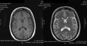 Gadolinium-enhanced brain MRI at 4 months since initiation of treatment with resolution of the lesions with no evidence of neuroinfection.