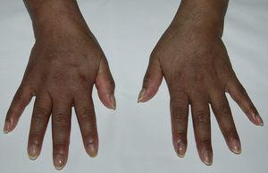 Hyperpigmentation on the back of the hands and lineal melanonychia.
