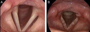 Videolaryngostroboscopy. (A) Exploration under normal breathing. (B) Bamboo nodules with signs of reflux, including arytenoid hyperemia and thickening of the posterior commissure.