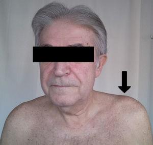 Photograph of a patient suffering from septic arthritis of the ACV joint. There is a certain swelling and cutaneous erythema in the upper left shoulder.