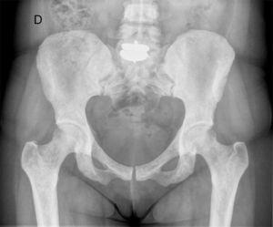 X-ray of pelvis: showing round or oval radiodense lesions on the head, neck and intertrochanteric region of both femurs and pelvis.