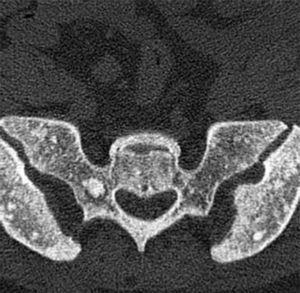 CT pelvis: small hyperdense areas in the sacrum and iliac bones, both <10mm without signs of malignancy.