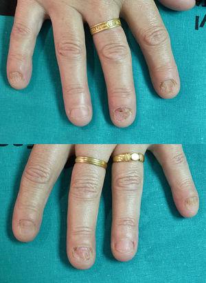 Nail disorders by onychophagia: absence of the distal end of the nail, subungual ecchymosis, callus type mechanical injury, deformity of the paronychium and characteristic grooves in the nail, indicative of chronic trauma of the nail bed.