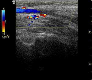Image of humeral artery thrombosis.
