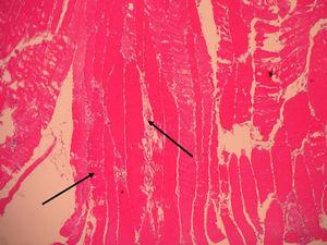 Muscle biopsy 100×. Increase in volume, discoloration and destruction of muscle fibers surrounded by an inflammatory infiltrate.