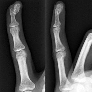 Anteroposterior (A) and lateral (B) X-rays of the fifth finger of the left hand showing an ossified nodular lesion attached to the periosteum of the distal phalanx without cortical erosion.