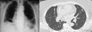  Posteroanteriore Thoraxröntgenaufnahme und Thorax-CT, bei der der Volumenverlust beider Lungen und die Atelektase in den Basen geschätzt werden.