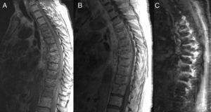 MRI of thoracic spine, sagittal spin echo T1 sequences, with (A) and without contrast (B), and STIR (fat suppression) (C) sequence, where extensive epidural and paravertebral soft tissue involvement is observed reducing the diameter of the spinal canal, with a small D7–D8 prevertebral abscess.