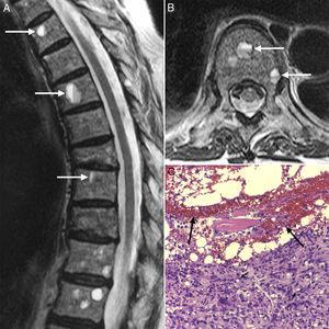 Dorsolumbar spine magnetic resonance showing, in sagital (A) and axial (B) projections of a T2 potentiated sequence, the presence of multiple vertebral lesions with typical fluid–fluid levels, hyperintense superiorly and hypointense inferiorly. A bone biopsy (C) revealed that these lesions corresponded to metastasis of a poorly differentiated adenocarcinoma with signet ring cells (arrowheads), surrounding a hemorrhagic content (arrows) (hematoxilin-eosin 10×).